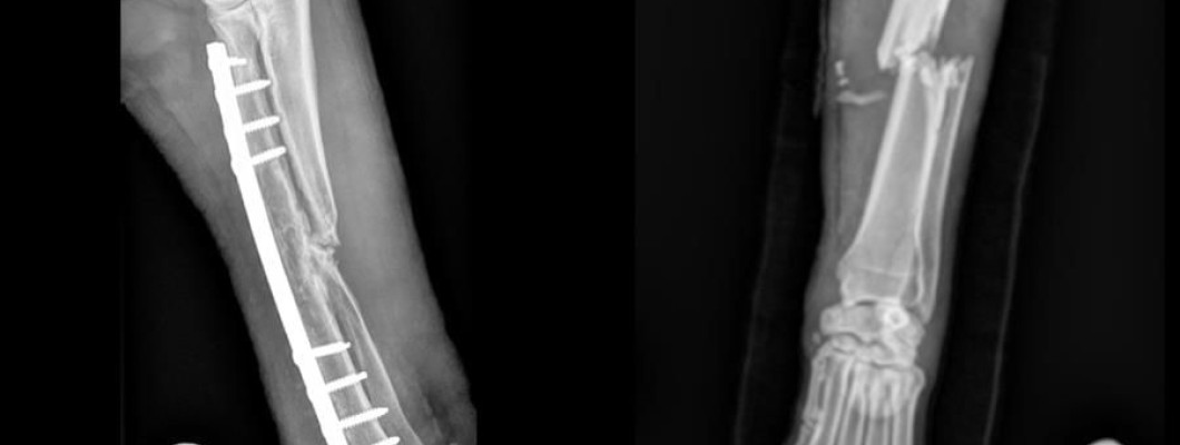 病例分享 ：以 ARCIS® 固定系統處置之高難度骨折修復