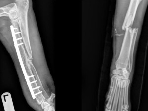 病例分享 ：以 ARCIS® 固定系統處置之高難度骨折修復