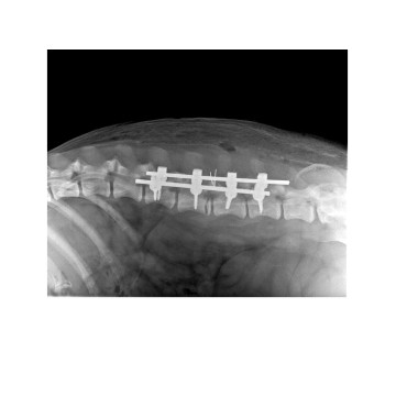 椎根釘固定系統 invetra™ Pedicle Screw Fixation System