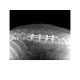 椎根釘固定系統 invetra™ Pedicle Screw Fixation System