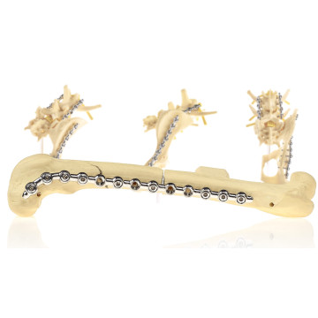 鎖定骨板系統 SOP ™