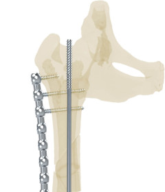 髓內釘系統 NXP™ System