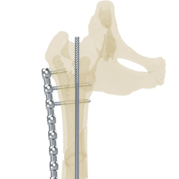 髓內釘系統 NXP™ System 