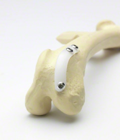 髕骨穩定植入系統 RidgeStop™ System