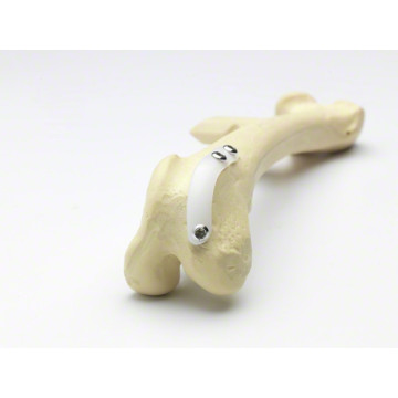 髕骨穩定植入系統 RidgeStop™ System