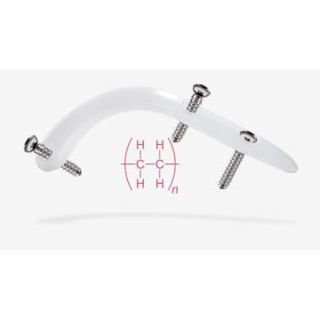 髕骨穩定植入系統 RidgeStop™ System